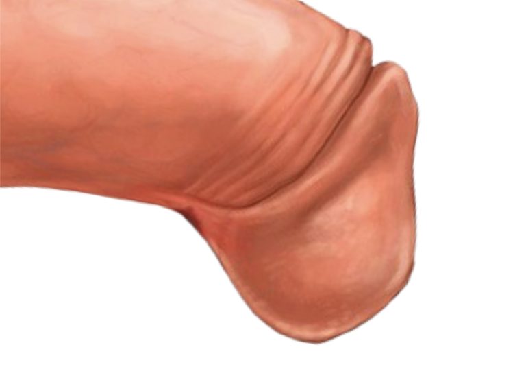 frenuloplastia_laser